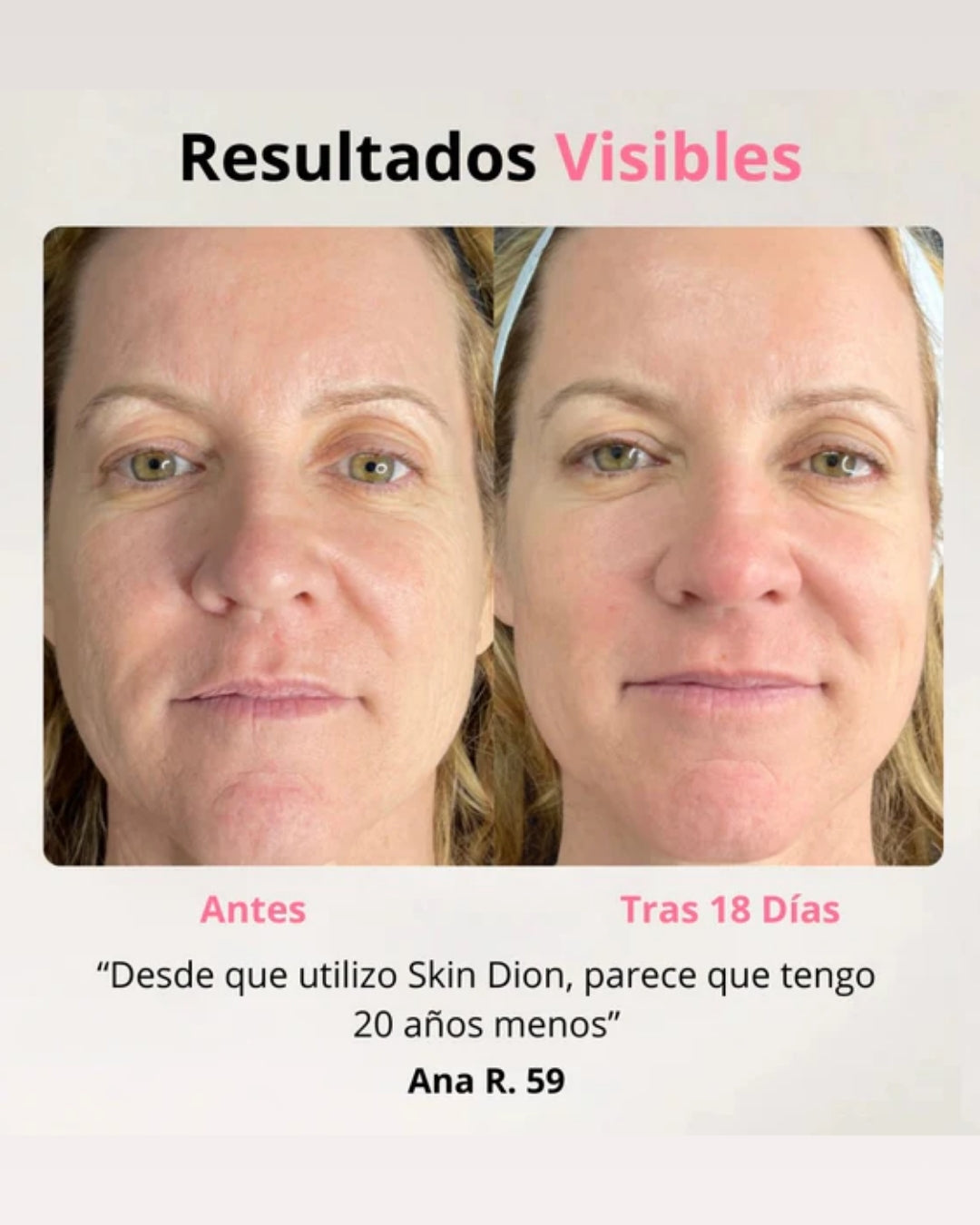 Skindion™ Dispositivo de Lifting Facial