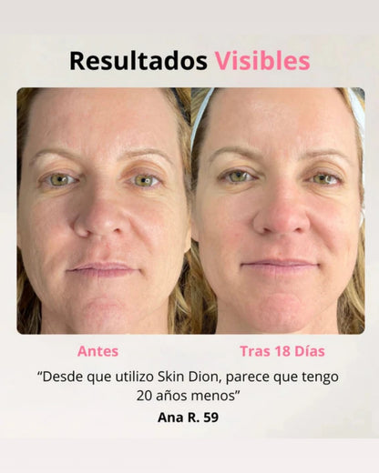 Skindion™ Dispositivo de Lifting Facial
