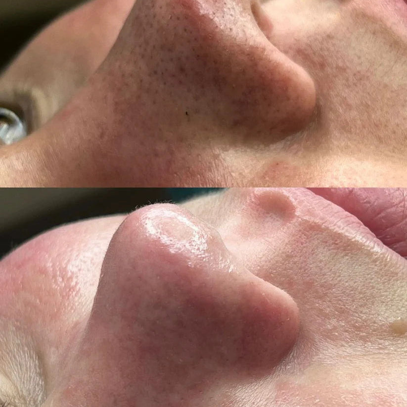 UltraScrub - Espátula Ultrasónica Facial